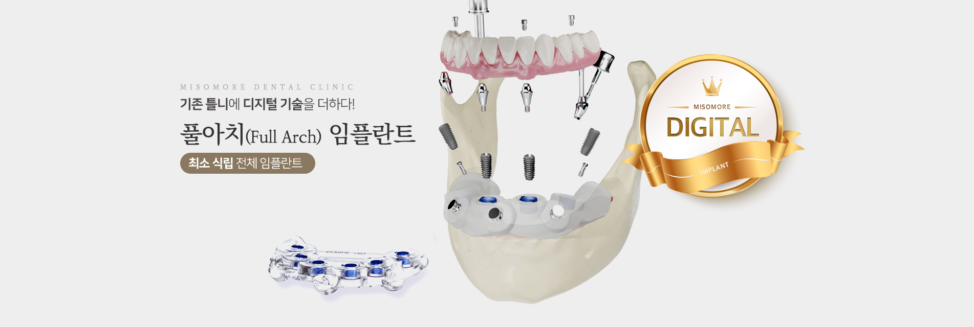 기존 틀니에 디지털 기술을 더하다! 풀아치 임플란트