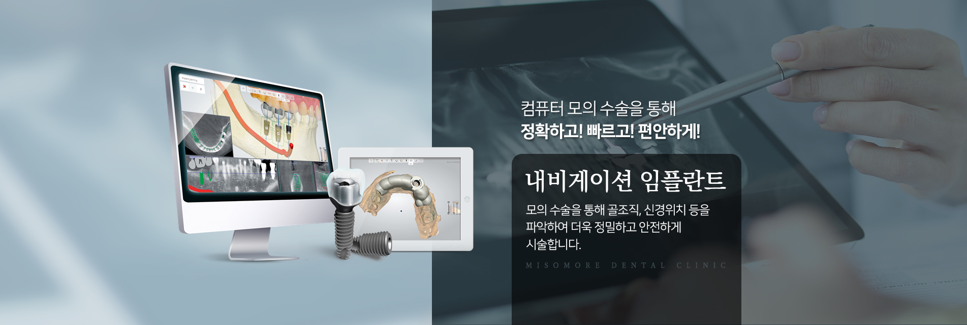 컴퓨터 모의수술을 통해 정확하고! 빠르고! 편안하게! 내비게이션 임플란트