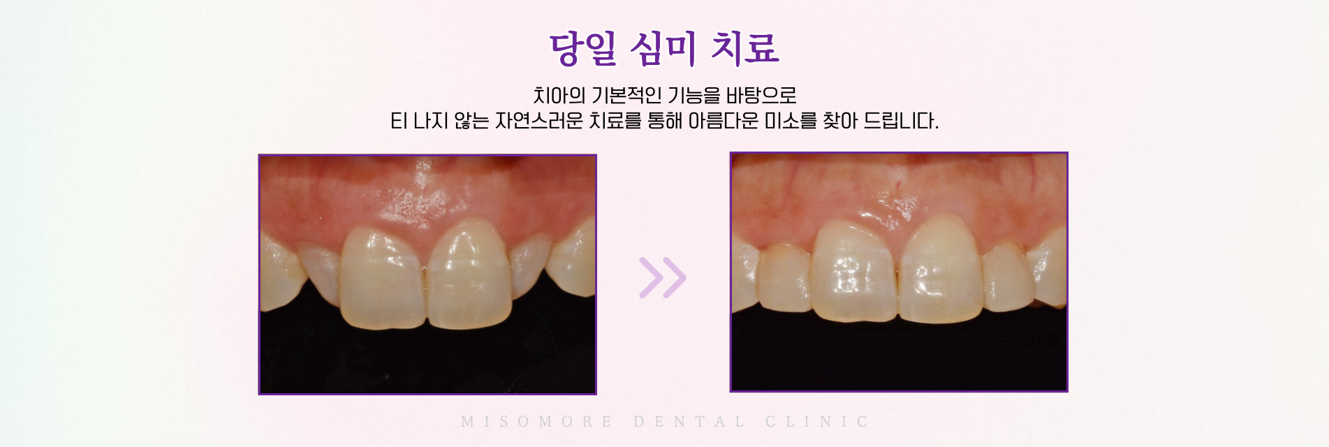 당일 심미 치료