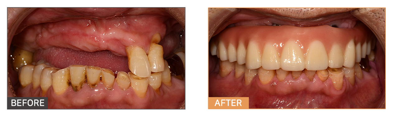 풀아치임플란트 케이스2
