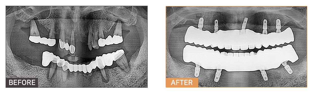 풀아치임플란트 케이스3
