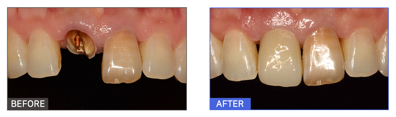 원데이 임플란트 케이스1