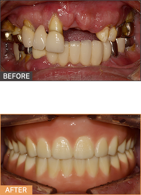 풀아치임플란트 케이스1