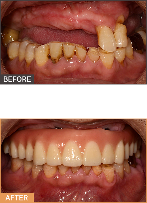 풀아치임플란트 케이스2