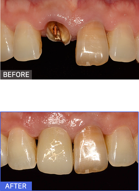 원데이임플란트 케이스1