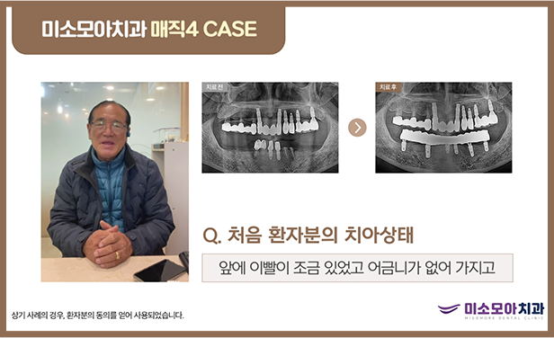 미소모아 치과 리얼스토리1