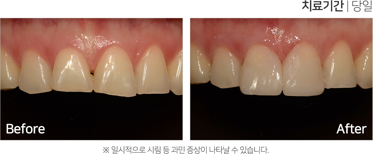 심미 치료 케이스1