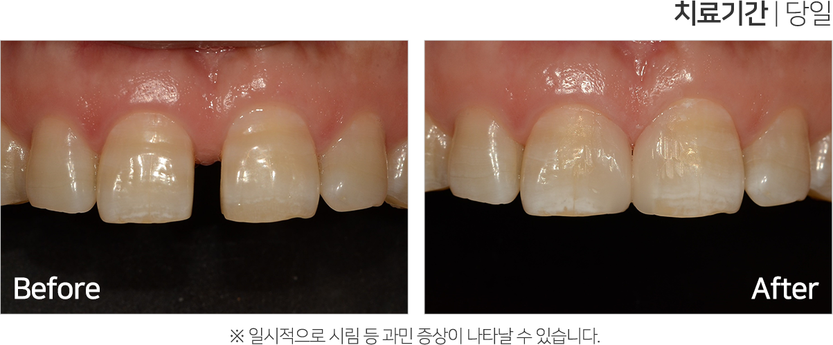심미 치료 케이스2