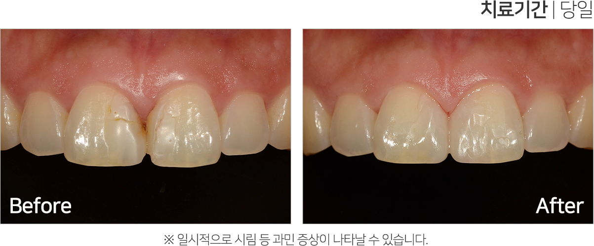 심미 치료 케이스3