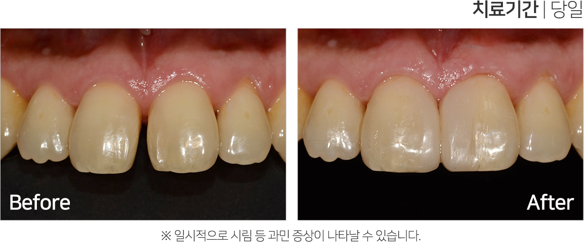 심미 치료 케이스4