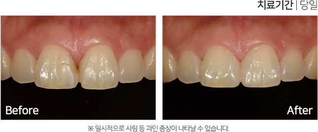 심미 치료 케이스3
