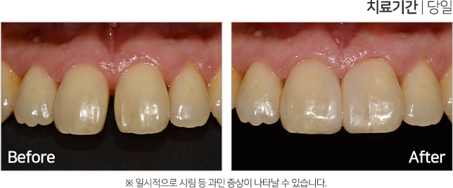 심미 치료 케이스4