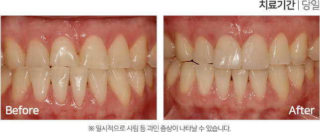 심미 치료 케이스5